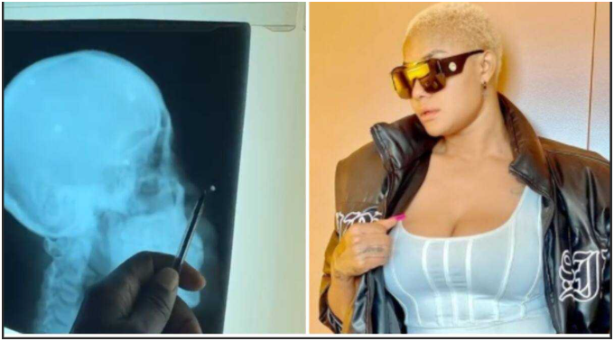 Angela Okorie Bullet Fragments Head